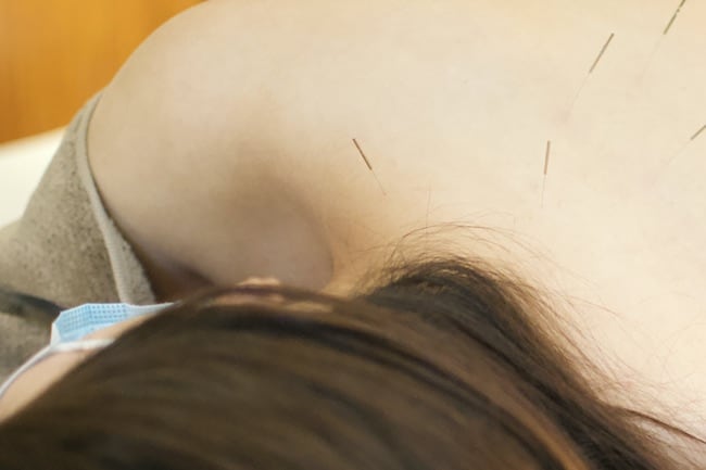 妊婦さんへの鍼施術