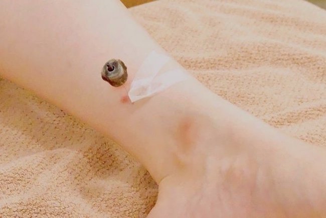 三陰交への灸頭鍼